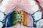 Palatal Expander